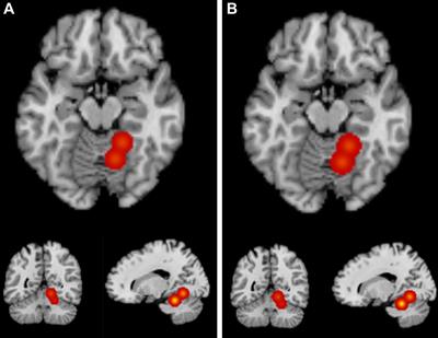 A Meta-Analysis of Gray Matter Differences Between Bilinguals and Monolinguals